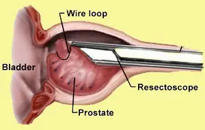 μονοπολική ή διπολική διουρηθρική προστατεκτομή χειρουργικές θεραπείες υπερπλασίας προστάτη Χειρουργός Ουρολόγος
