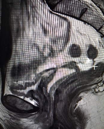 κυστεοκοπλικό συρίγγιο όπως απεικονίζεται στη μαγνητική τομογραφία