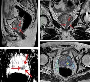 εικόνες μαγνητικής τομογραφίας προστάτη με την ανάδειξη ύποπτων περιοχών (βέλη) από fussion βιοψία προστάτη